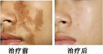 激光去咖啡斑 有效击退色斑