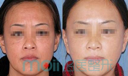 玻尿酸,川字纹,对比图,长春好的整形医院