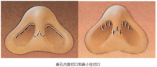 鼻部整形,切口,长春好的整形医院