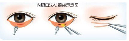 内切口法,祛眼袋,示意图,长春好的整形医院
