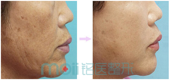 肉毒素,注射,对比图,长春好的整形医院