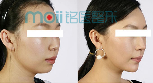 玻尿酸,丰下巴,对比图,长春好的整形医院