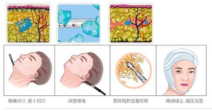 面部吸脂,示意图,长春好的整形医院