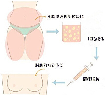 自体脂肪,隆胸,过程,长春好的整形医院