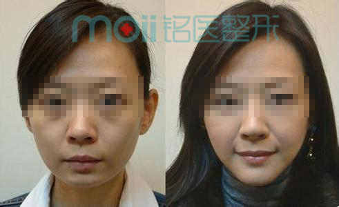 玻尿酸,丰下巴,对比图,长春好的整形医院
