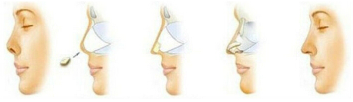 自体软骨隆鼻,过程,长春好的整形医院