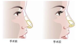 鹰钩鼻,前后,对比图,长春好的整形医院