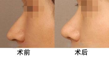 箭鼻,矫正,对比图,长春好的整形医院