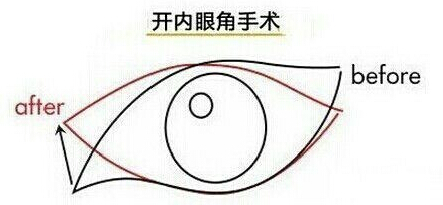 开内眼角,开外眼角,区别,长春好的整形医院
