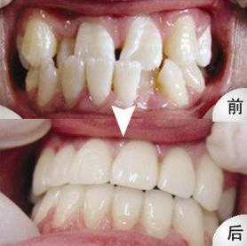 牙齿拥挤,矫正,对比图,长春好的整形医院