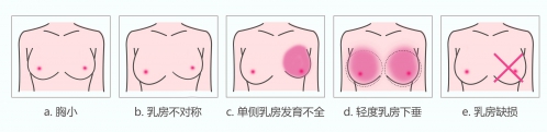 自体脂肪隆胸,适应人,长春好的整形医院