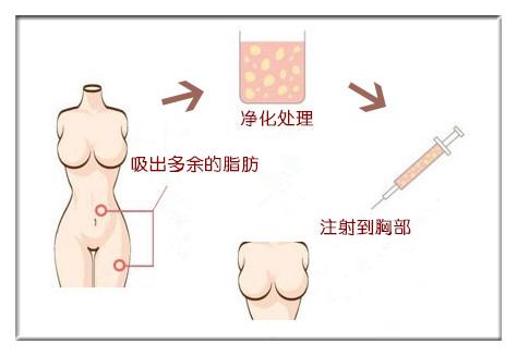 自体脂肪隆胸,步骤,长春好的整形医院