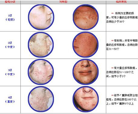 痤疮,级别,长春好的整形医院