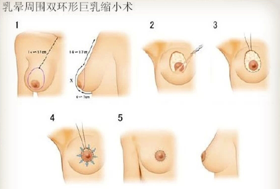巨乳缩小手术,过程,长春好的整形医院