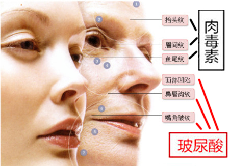 玻尿酸,肉毒素,对比图,长春好的整形医院
