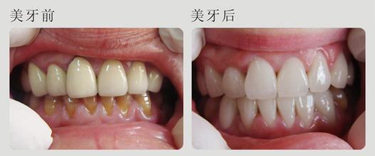 烤瓷牙,修复,对比图,长春好的整形医院