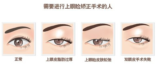 上睑下垂矫正术,图示,长春好的整形医院