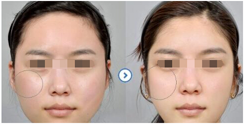 去颧骨,对比图,长春好的整形医院