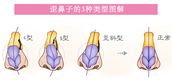 歪鼻,类型,长春好的整形医院