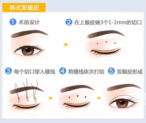 韩式,双眼皮,长春好的整形医院