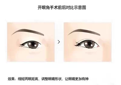 开眼角,对比,示意图,长春好的整形医院