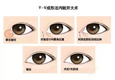 Y-V成形法,开眼角,示意图,长春好的整形医院