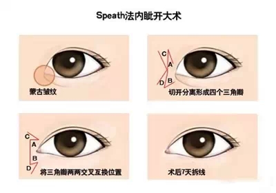 Speath法,开眼角,示意图,长春好的整形医院