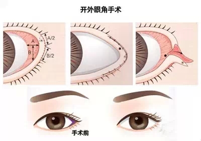 开外眼角,内外眼角,区别,长春好的整形医院