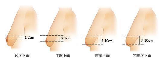 乳房下垂,分类,分度,长春好的整形医院