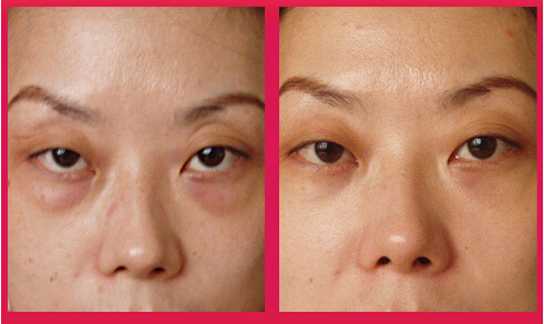 黑眼圈和黑眼袋有什么区别?