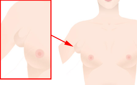 副乳,长春好的整形医院