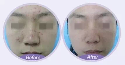 果酸换肤,对比图,长春好的整形医院