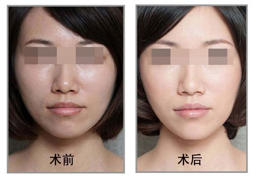 果酸焕肤,换肤,对比图,长春好的整形医院