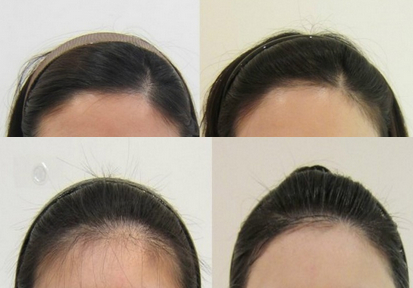 发际线,5度冰点,脱毛,对比图,长春好的整形医院