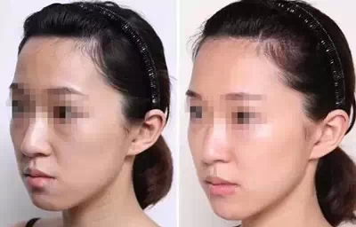玻尿酸,苹果肌,对比图,长春好的整形医院