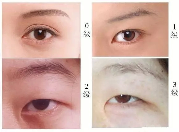 内眦赘皮,分级图,对照,长春好的整形医院