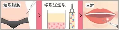 自体脂肪,丰唇,对比图,长春好的整形医院
