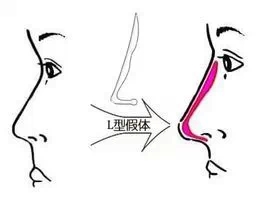 L型假体,长春好的整形医院