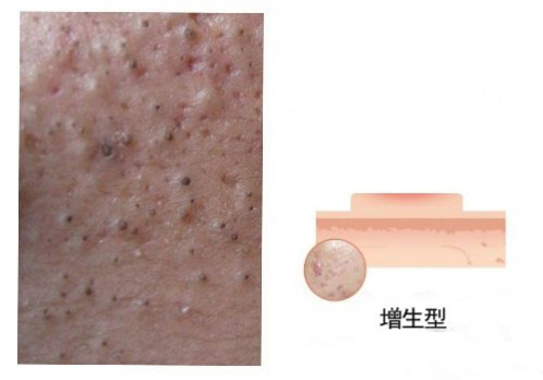 增生性凸疤,祛痘印,长春好的整形医院