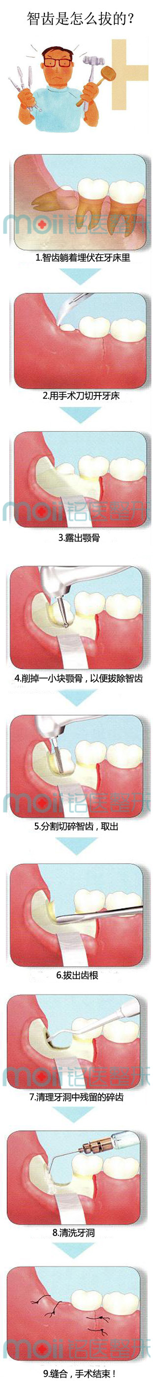 拔智齿,流程图,长春好的整形医院