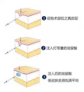玻尿酸,填充,鼻唇沟,过程,长春好的整形医院