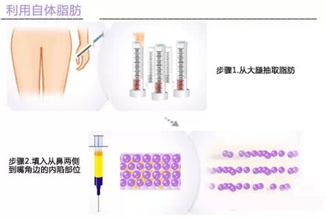 自体脂肪,填充,鼻唇沟,长春好的整形医院