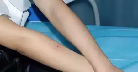 冰点脱毛,过程,长春好的整形医院