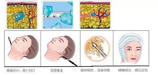 面部吸脂,示意图,长春好的整形医院