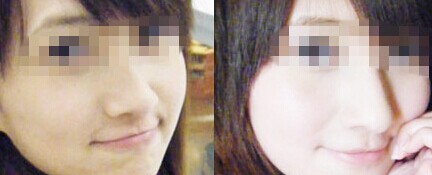 面部自体脂肪填充多少钱