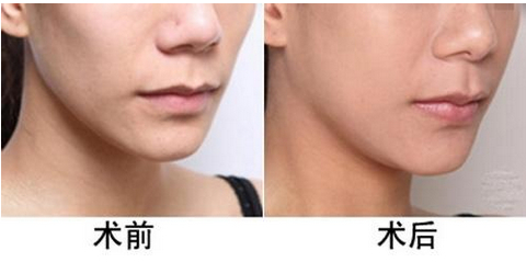 丰面颊手术前后对比图