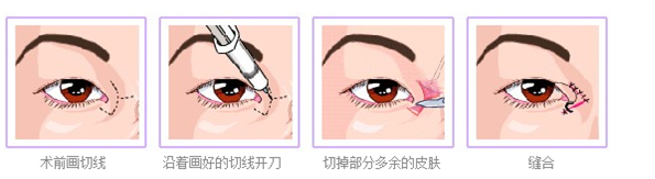 开眼角恢复过程图