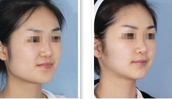 长春瘦脸针,瘦脸针效果图,铭医瘦脸针