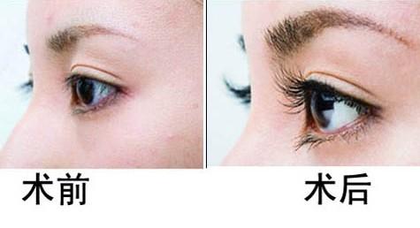 长春睫毛移植,睫毛变长变密,铭医移植睫毛