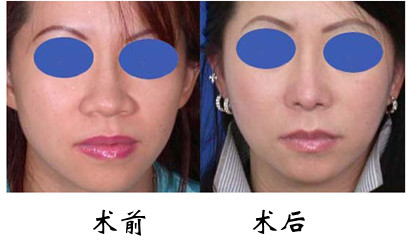 长春鼻翼缩小,鼻翼缩小手术,缩小鼻翼
